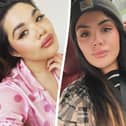 Lorna Holmes with lip filler and after it was dissolved. 