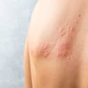 You should get advice from 111 as soon as possible if you think you have shingles