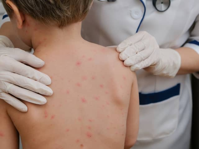 Chickenpox is a viral infection that mostly affects children, although you can get it at any age