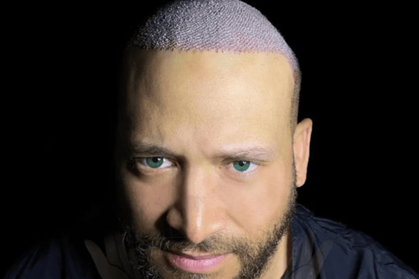 Aslı Tarcan Clinic is a leading destination for anyone considering hair transplant procedure in Turkey