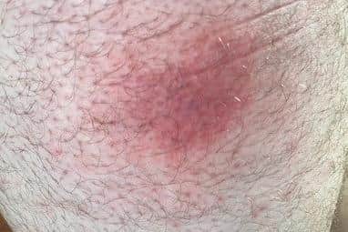 A tick bite on the leg of a walker who was wading through waist-high heather in the Peak District, September 2023.