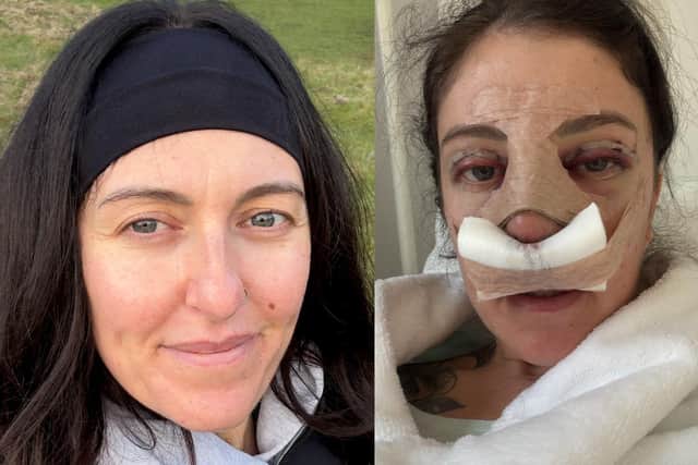 Self-conscious Kayley Abbott, 36, flew to Kaunas, Lithuania, to have upper blepharoplasty surgery - removing part of her eyelids' skin to prevent "hooded eyes"
