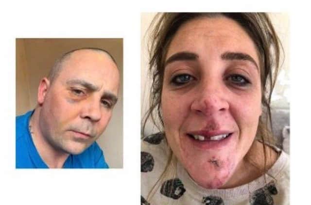 Gavin and Suzanne Webb with their assault injuries
