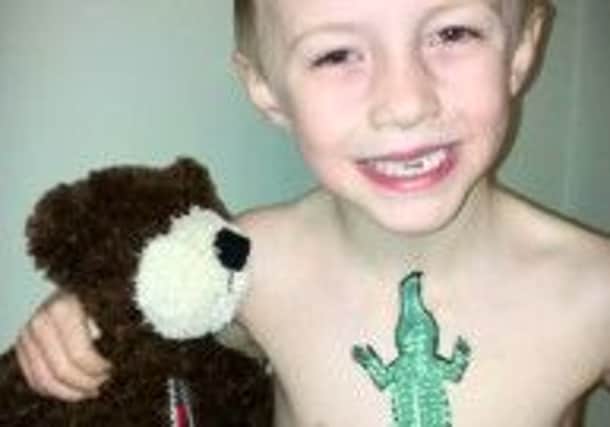Alfie Frawley, who has had a crocodile painted over his scar as part of an art project. Photo contributed.