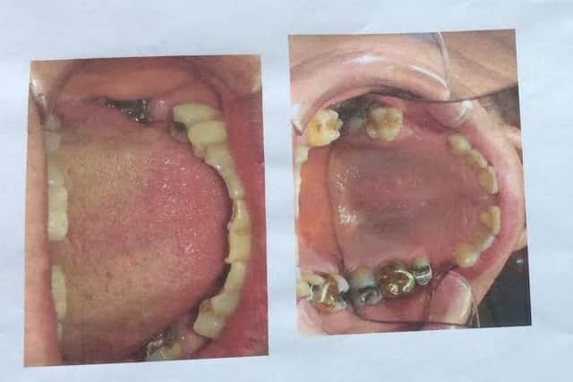 Pictured are the teeth of Geoffrey Titchener, 70, of Chesterfield.