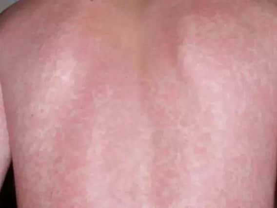 A Scarlet Fever rash